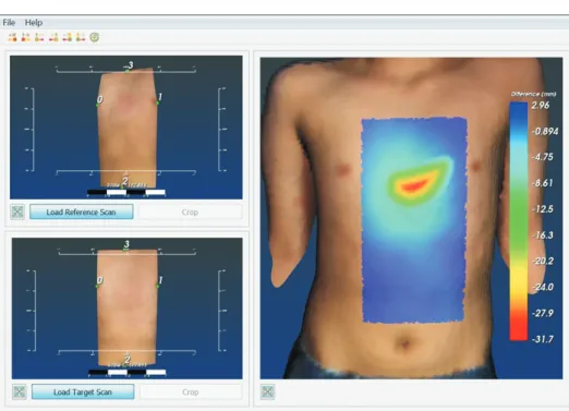 Fig. 3. Software used to compare 2  scans of the chest wall: landmark-  based alignment and registration  (left) and difference color map in  mm (right).