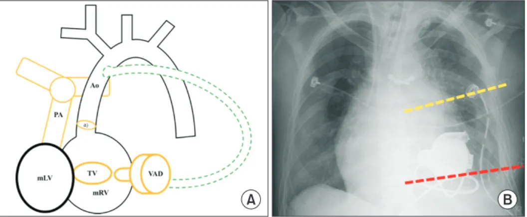 Fig. 2. (A) Diagram of the patient’s postoperative status. The green dotted line is the outflow tract, which was inserted on the left side  of the ascending aorta