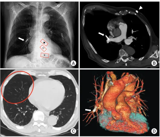 Fig. 1. MDCT after TPS implanta- implanta-tion in a 64-year-old man with  bra-dyarrhythmia and atrial fibrillation
