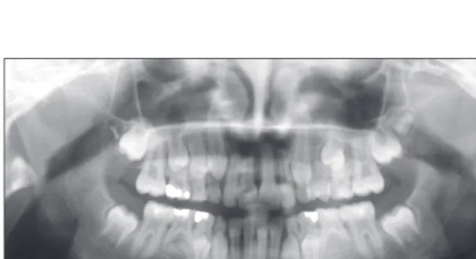 Figure 2. Panoramic radiograph of the patient aged 9  years and 6 months indicating mandibular right second  premolar formation 17 months after initial diagnosis.