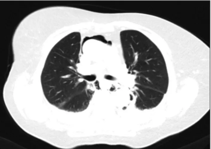 Fig. 3. Computed tomography scan showing pneumomediastinum.