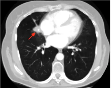 Fig. 1. Computed tomography scan of the chest before the oper- oper-ation, showing a centrally located solid lesion, measuring 16×15  mm, with smooth margins (arrow).