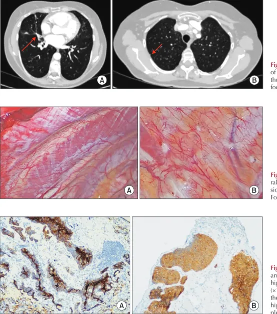 Fig. 2. Computed tomography scan  of the chest. (A) Local recurrence in  the middle lobe (arrow)