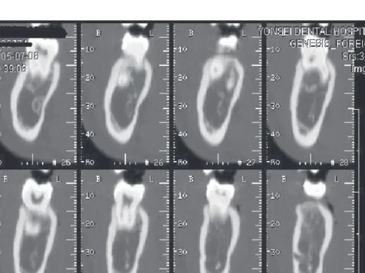 Figure 1. Representative computed tomography (CT) image of the transaxial slices of the mandibular body, as displayed  by the PiView STAR program (INFINITT, Seoul, Korea).