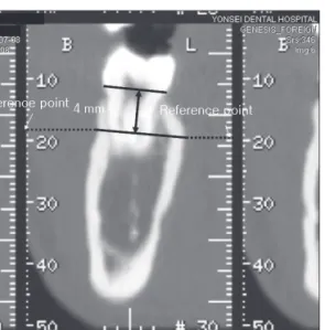 Figure 3. Reference lines placed on the measurement site. Figure 4. Measurement of buccal cortical bone thickness  (BCBT) and lingual cortical bone thickness (LCBT).