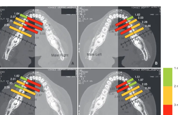 Table 6. Differences in cortical bone thickness between  interdental regions