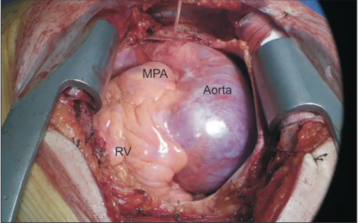 Fig. 1. Computed tomography revealed Stanford type A acute  aortic dissection and situs inversus totalis