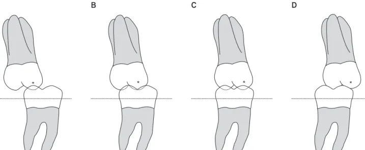 Figure 3. Guidelines used for classifying molar relationships from the lingual aspect
