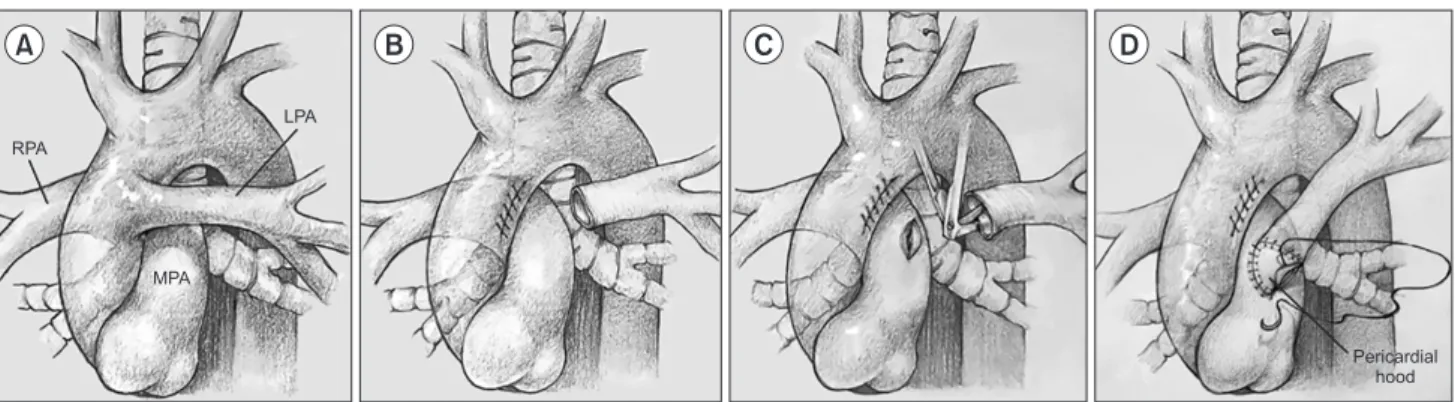 Fig. 2. Reimplantation technique for the left pulmonary artery. (A) Abnormal anatomy of left hemitruncus arteriosus: anomalous origin  of the left pulmonary artery from the ascending aorta