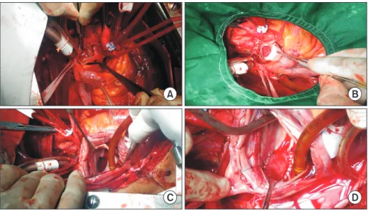 Fig. 2. (A) Opening in the RPA. (B)  Dacron patch closure of the RPA  opening. (C) Opening in the LA