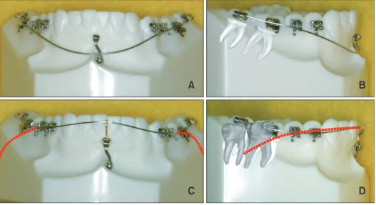 Figure 1. Schematic illustration of the molar uprighting protocol. Components include a C-tube plate on the symphysis,  bonded target posterior teeth, and a reverse-curve NiTi archwire
