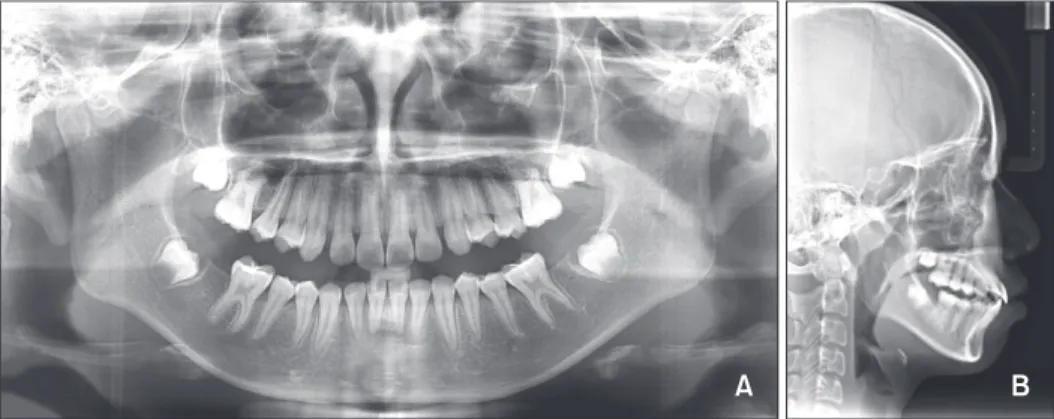 Figure 3. Pre-treatment. A, Panoramic radiograph and B, lateral cephalogram.