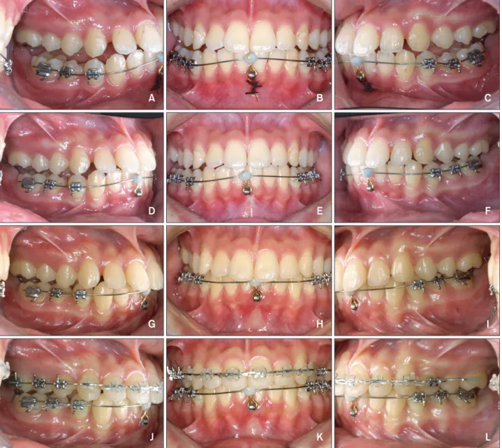 Figure 5. Treatment progress. A-C, Immediately after bonding; D-F, after 3 months; G-I, and after 4 months; J-L, molar  uprighting achieved a Class I molar relationship and spontaneous bite closure.