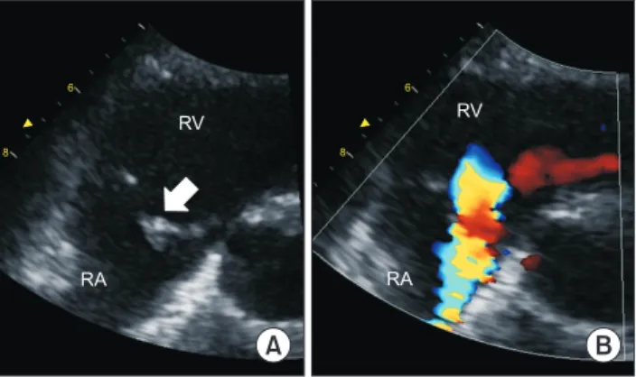 Fig. 1. (A, B) Zoomed-in image of the tricuspid valve in the para- para-sternal short-axis view during preoperative echocardiography  showing the ruptured papillary muscle (white arrow), flailing  an-terior leaflet, and severely eccentric tricuspid regurgi