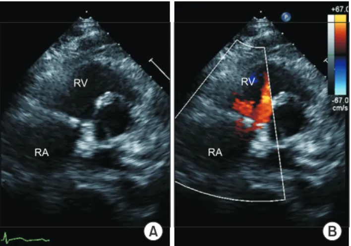Fig. 3. (A, B) Parasternal short-axis view obtained during postop- postop-erative echocardiography shows good coaptation of the tricuspid  valve without regurgitant flow