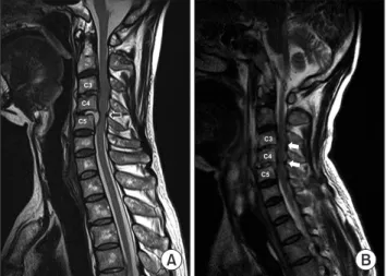 Fig. 1. (A) Initial cervical MRI showing an abscess with inflam- inflam-matory changes in the epidural space and prevertebral portion of  C4–C5 (black arrow)