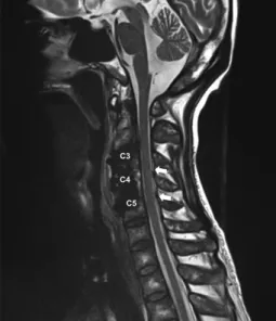 Fig. 2. After emergent neurosurgery, follow-up magnetic reso- reso-nance imaging of the cervical spine showed successful removal  of the abscess and a decompressed spinal cord at C3–C5 (white  arrows).