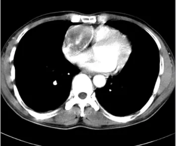 Fig. 1. Preoperative computed tomography image demonstrates a  mass-like lesion in the right heart.
