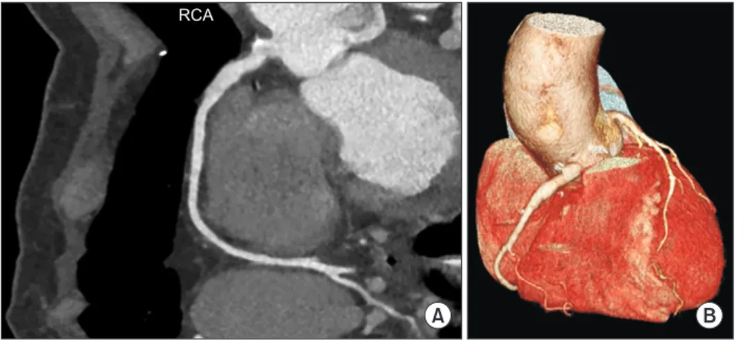 Fig. 3. (A, B) Follow-up computed  tomography images 18 years after  surgery showed patency of the  sa-phenous vein graft