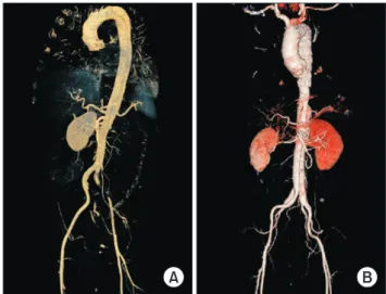 Fig. 1. Preoperative computed tomography showing malperfusion  of the left renal artery and left common iliac artery (A)