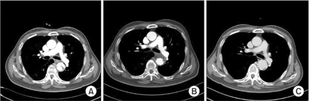 Fig. 2. Preoperative computed to- to-mography showing the dissected  thoracic aorta (A)