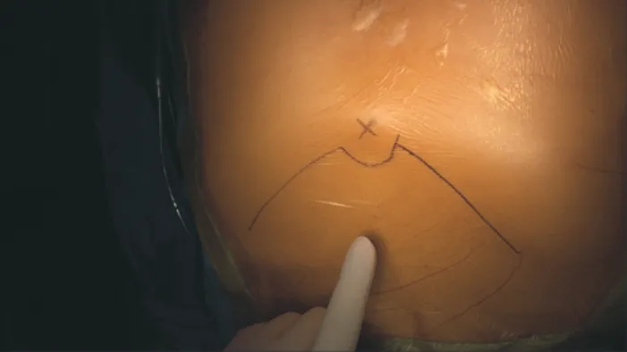 Fig. 3. Skin incision. A 5-cm horizontal incision is made below  the xiphoid process.