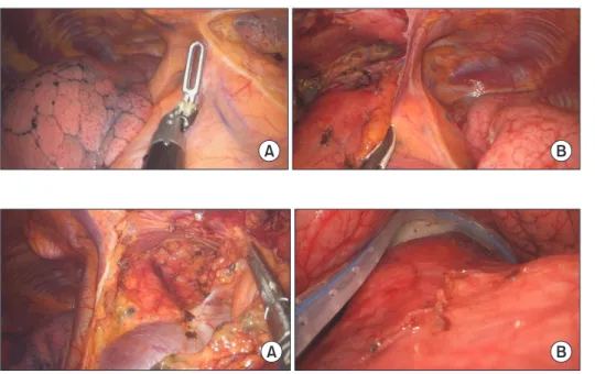 Fig. 8. Thymectomy. (A) Both upper  poles are removed and (B) a  Jack-son-Pratt drain is positioned after  retrieval of the mass.
