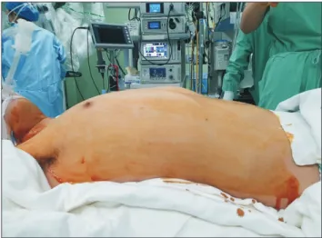 Fig. 3. Typical port placement for 3-arm robotic thymectomy via  the subxiphoid approach.
