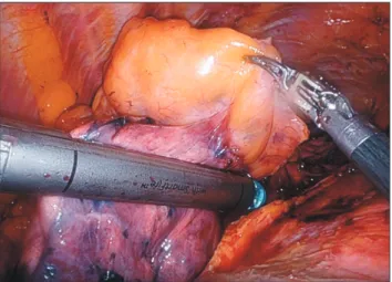 Fig. 6. The proximal innominate vein is divided with a robotic  stapler.
