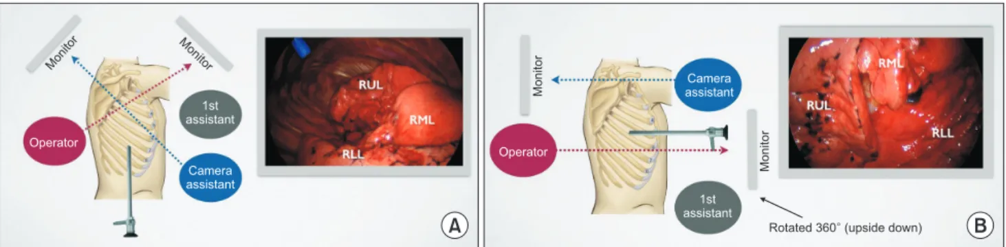Fig. 1. The location of the ports depends on the thoracoscopic view. (A) Conventional panoramic view