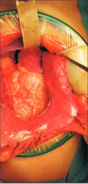 Fig. 1. Surgical view of midline laparotomy and gastric tube for- for-mation. Note that the 4-cm length of the uppermost fundus is left  intact, not fully divided.