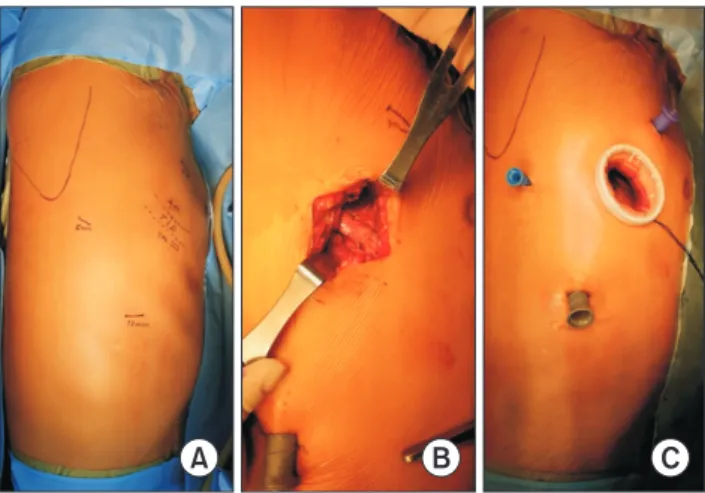 Fig. 2. (A) The location of the ports to be placed is shown by a  marker pen. (B) A 4-cm segment of the fifth rib is resected for  sub-sequent easy passage of the extracorporeal procedures