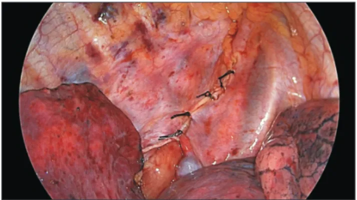 Fig. 7. The upper portion of the mediastinal pleura over the azy- azy-gous vein level is suture-repaired with multiple interrupted 3-0  silk sutures