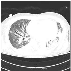 Fig. 1. Chest computed tomography image showing extensive  ground glass opacities and diffuse bronchiectasis in the bilateral  lungs.