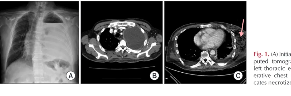 Fig. 1. (A) Initial chest X-ray. (B) Com- Com-puted tomography (CT) revealing  left thoracic empyema