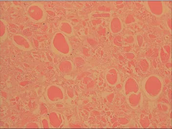 Fig. 3. Microscopic image of removed tissue reveals necrotic tis- tis-sues without nuclei (H&amp;E, ×200).
