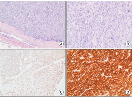 Fig. 3. (A) Cellular intrapulmonary  thymoma surrounded by a thick  fi-brous capsule (H&amp;E, ×100)