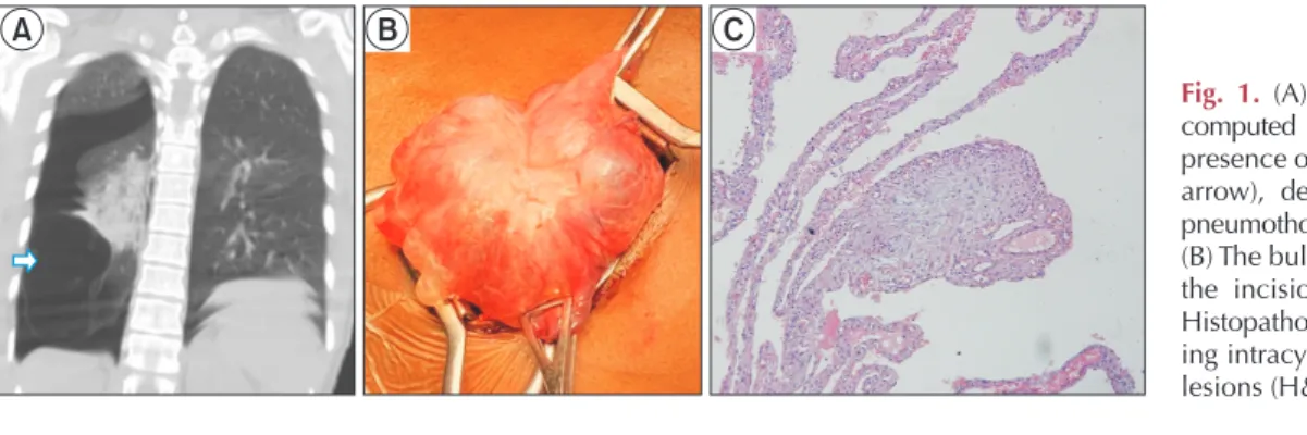 Fig. 1. (A) Coronal view of chest  computed tomography showing the  presence of a double air line (white  arrow), denoting the presence of  pneumothorax and lower lobe bulla