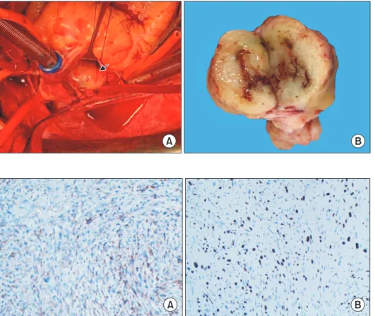 Fig. 3. Immunohistochemical stain- stain-ing showed positivity for vimentin  (A, original magnification ×100) and  intense expression of S100 (B,  orig-inal  magnification ×100).