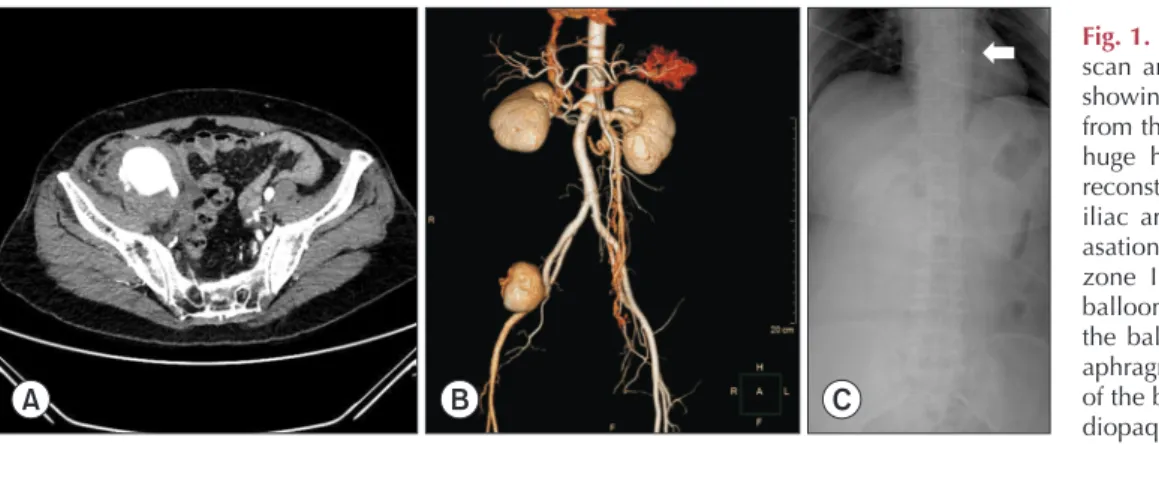 Fig. 1. Computed tomography (CT)  scan and radiograph. (A) CT scan  showing the site of active bleeding  from the external iliac artery and a  huge hematoma