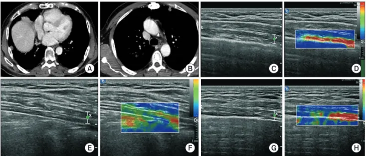 Fig. 1. (A, B) Computed tomography scan showing bilateral lung nodules and no pleural thickening