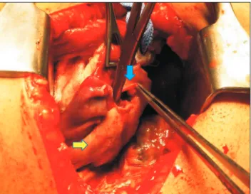 Table 1. Reported cases of chest wall necrotizing fasciitis secondary to tube thoracostomy Author Patient 