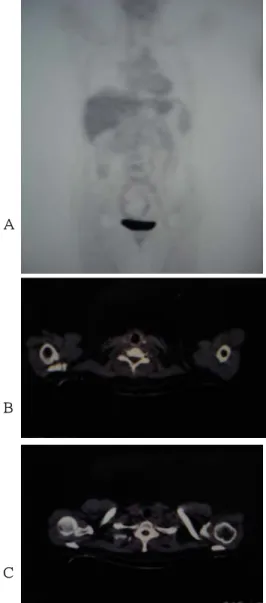 Fig. 2. Preoperative FDG-PET scan. No lesion of high uptake was seen. A. PET image, B,C