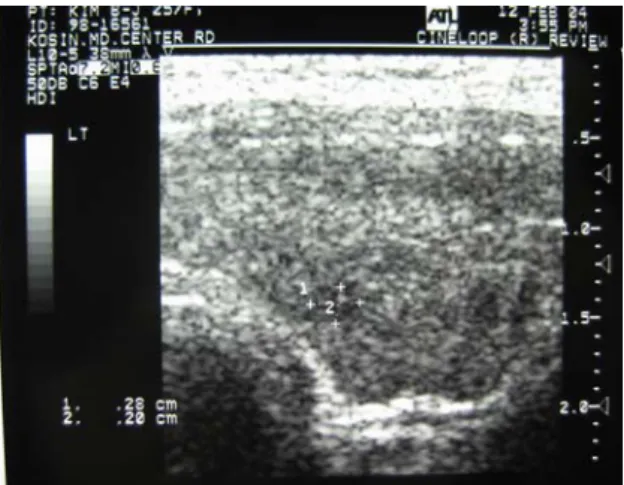 Fig. 1. Ultrasonography of the thyroid. The both thyroid glands are enlarged. Ill defined 0.2cm sized nodule-like lesion is noted at the both thyroid lobes.