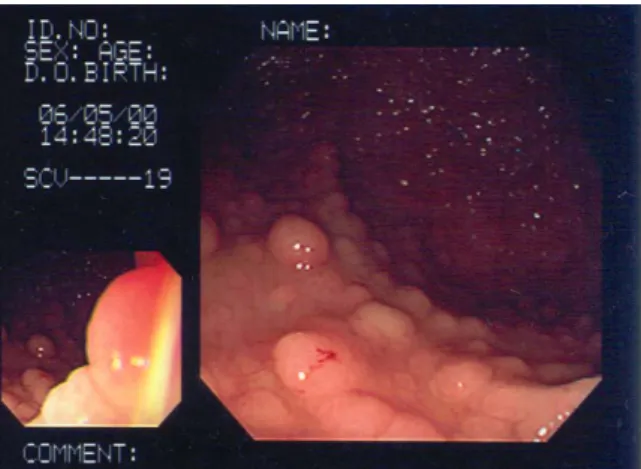 Fig. 2. Colonosocpic findings. From rectum to cecum, variable sized hundreds polyps were scattered(rectum dominant).