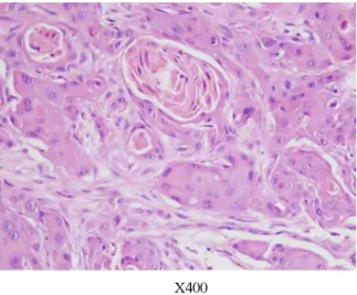 Figure 3. (A) Microscopic finding (H&amp;E) shows moderate differentiated squamous cell carcinoma with keratin pearl but do not find any glandular tissue.