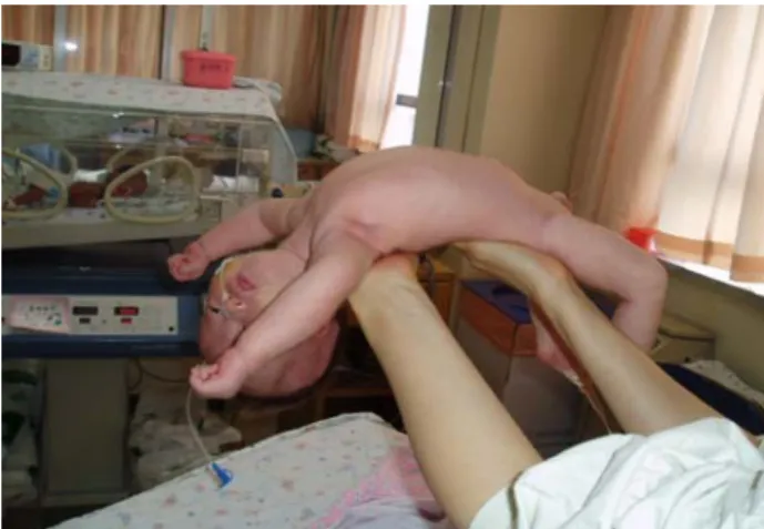 Figure 1. Hypotonia feature in Prader-Willi syndrome with drop of the head