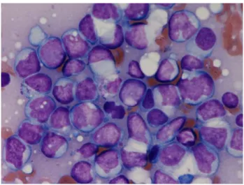 Fig. 1 Congenital leukemia cutis. The patient had multiple blue-violaceous nodules on his face, trunk, and extremities.
