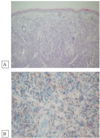 Fig. 3 Hematoxylin-eosin and immunohistochemistry stains on skin biopsy.