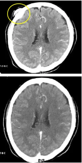 Fig. 2 Axial CT section at the level of cerebrum before and after the administration of bortezomib and dexamethasone.